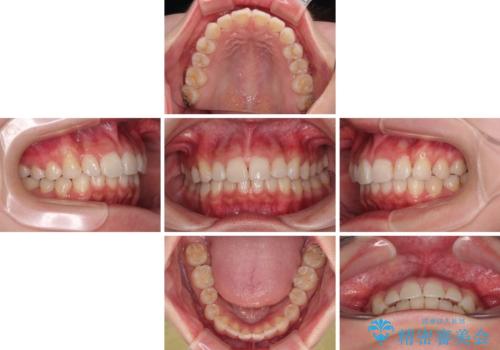 デコボコと咬み合わせを改善 インビザライン矯正治療の治療中