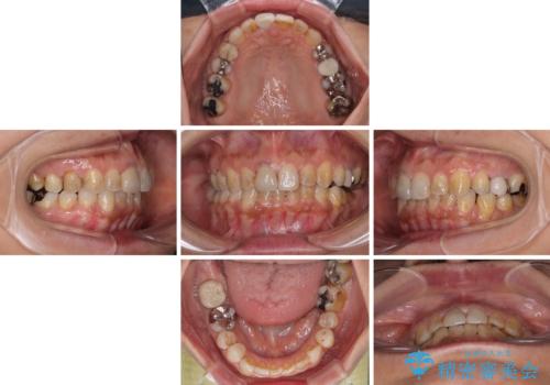むし歯治療とインビザライン矯正治療 総合歯科治療で整った口腔内にの治療中
