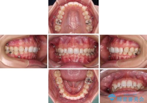 前歯のデコボコと小さい歯を改善　インビザラインとオールセラミッククラウンの治療中