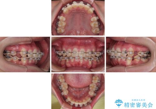 全体的なデコボコをスッキリと ワイヤー装置での抜歯矯正の治療中