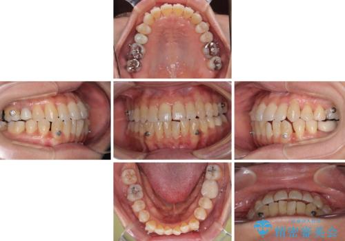 受け口と八重歯を改善 インビザライン矯正治療の治療中