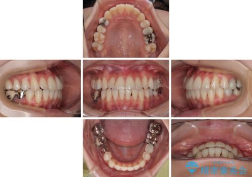 【モニター】前歯のデコボコをインビザラインで綺麗にの治療中