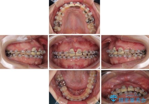 前歯のデコボコをワイヤー矯正で綺麗に　保険診療の前歯クラウンもセラミッククラウンで自然にの治療中