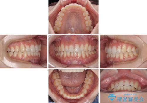 前歯が隠れるほどのデコボコをインビザライン矯正できれいに整えるの治療中
