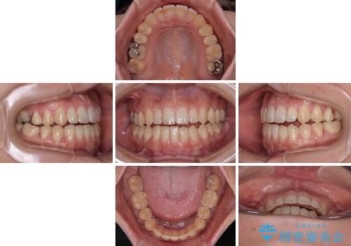 【モニター】食事が取りづらい 極端な開咬をインビザラインで解決の治療中