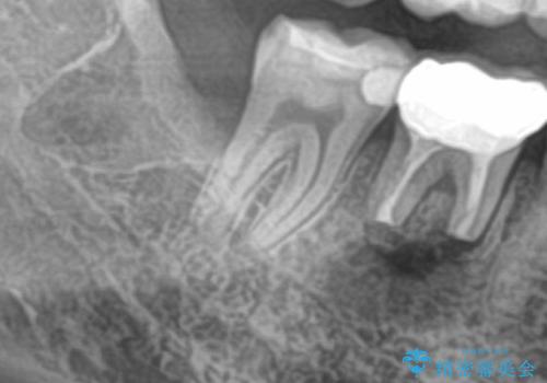 右下の親知らずを抜きたい 親知らず抜歯の治療後