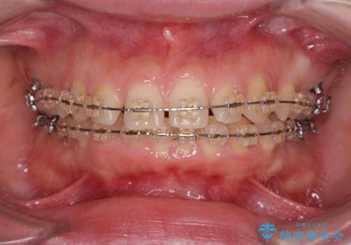 深い噛み合わせ、すきっ歯の改善　ワイヤーを用いたマルチブラケット矯正の治療中