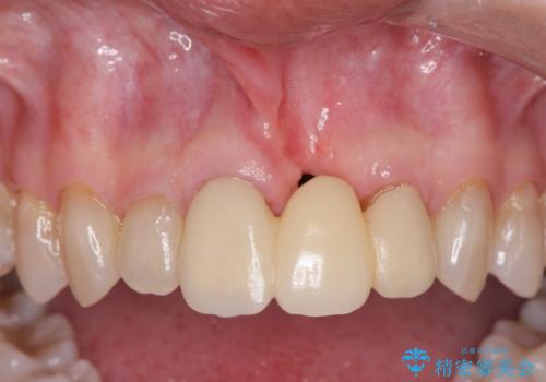 [ 欠損部の著しい骨欠損 ]　歯ぐきのボリュームを回復し自然なブリッジ作製治療の治療中