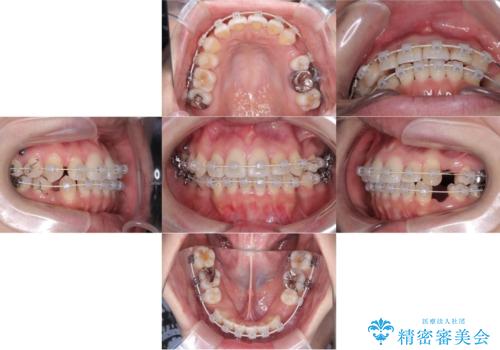 【ワイヤー矯正】口元を下げたい、下の歯の凹凸を無くしたいの治療中