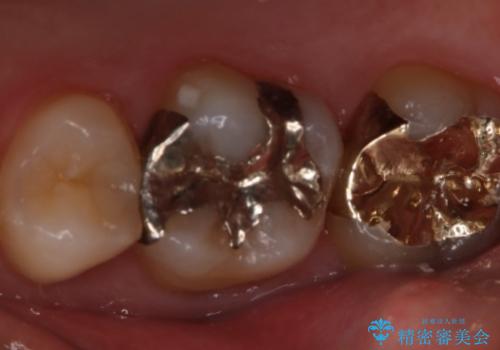 銀歯を金歯にしたい　ゴールドインレーの治療前