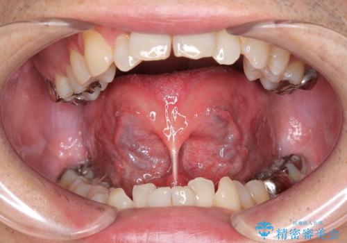 【舌小帯切除】ら行が言いづらいの症例 治療前