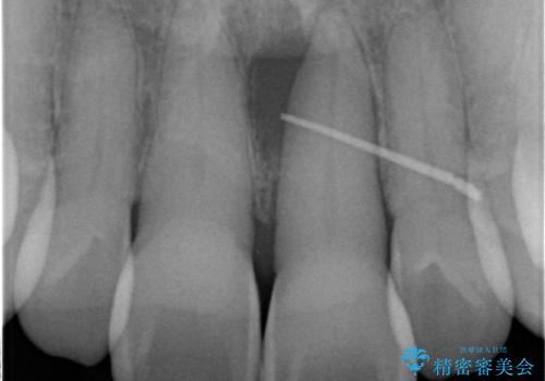 [ 欠損部の著しい骨欠損 ]　歯ぐきのボリュームを回復し自然なブリッジ作製治療の治療前