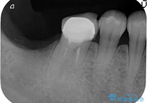咬合機能を回復する奥歯のインプラント治療の治療前