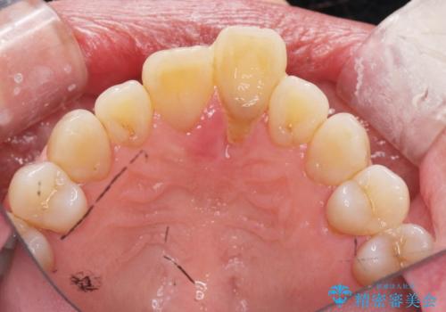 [ 欠損部の著しい骨欠損 ]　歯ぐきのボリュームを回復し自然なブリッジ作製治療の治療前