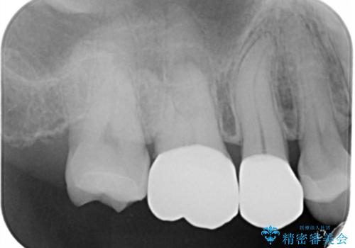 銀歯をやり変えたい　セラミックインレーの治療後
