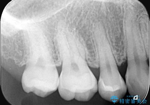 見逃しやすい小さな穴も精密に修復。自然な見た目のセラミックインレーの治療後