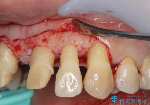 [ 再生療法 ]  歯周病治療を行った前歯のセラミック治療の治療中