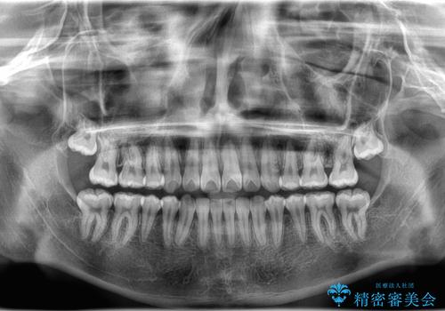 八重歯・歯並びのデコボコとディープバイトを改善した抜歯ワイヤー矯正症例の治療後