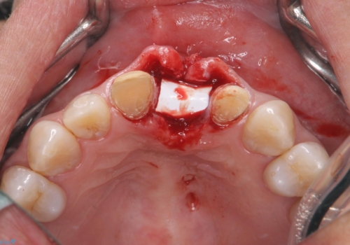 [ 欠損部の著しい骨欠損 ]　歯ぐきのボリュームを回復し自然なブリッジ作製治療の治療中