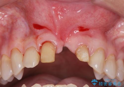 [ 欠損部の著しい骨欠損 ]　歯ぐきのボリュームを回復し自然なブリッジ作製治療の治療中