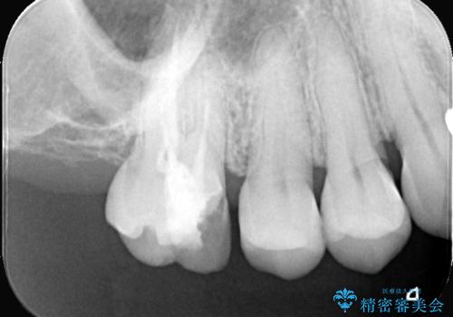詰め物が外れた奥歯。MB2の発見の治療前