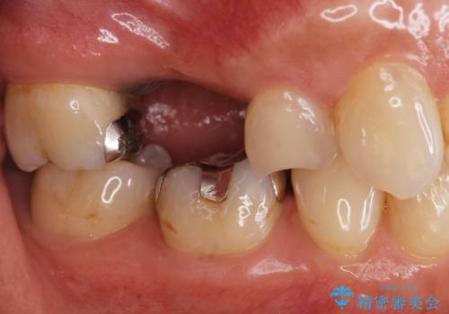 [ 奥歯の欠損 ] インプラントを用いた咬合機能の回復の治療前
