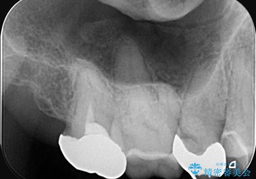 全ての銀歯をセラミックへ。お口全体をメタルフリーにして笑顔まで明るくの治療前