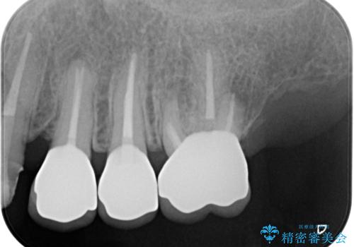 歯ブラシのしやすいクラウンへのやりかえ