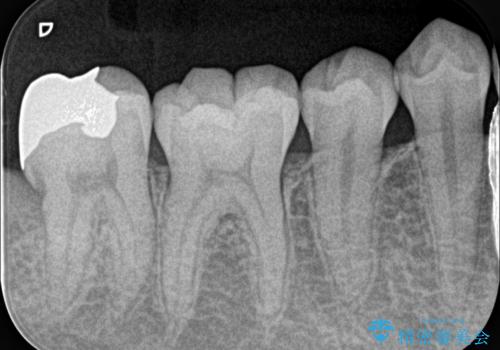 親知らず抜歯後、虫歯治療の治療後