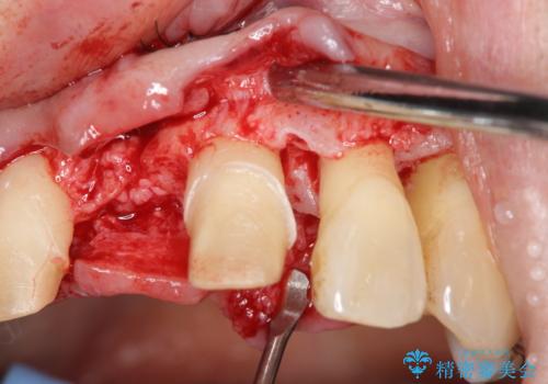 [ 再生療法 ]  歯周病治療を行った前歯のセラミック治療の治療前