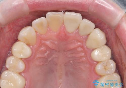 前歯の歯間に発生した虫歯のセラミック治療の治療後