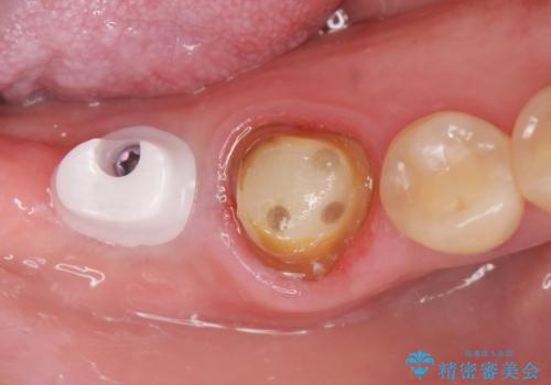 咬合機能を回復する奥歯のインプラント治療の治療中