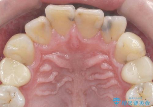 前歯の歯間に発生した虫歯のセラミック治療の治療前