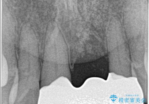 [ 欠損部の著しい骨欠損 ]　歯ぐきのボリュームを回復し自然なブリッジ作製治療の治療後