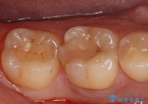 奥歯を良いもので治したい セラミックインレーの治療前