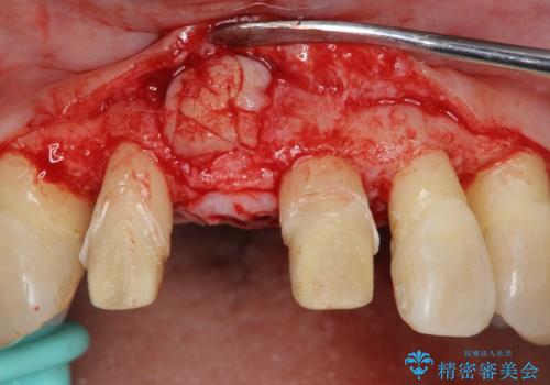 [ 再生療法 ]  歯周病治療を行った前歯のセラミック治療の治療中