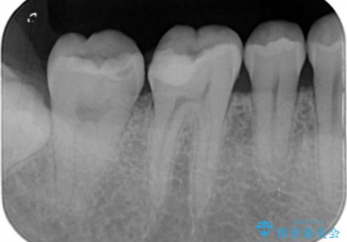 奥歯を良いもので治したい　セラミックインレーの治療前