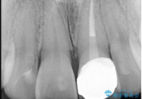 前歯の気になる変色を解消。再根管治療とオールセラミックで自然な美しさへの治療後