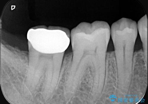 全ての銀歯をセラミックへ。お口全体をメタルフリーにして笑顔まで明るくの治療後
