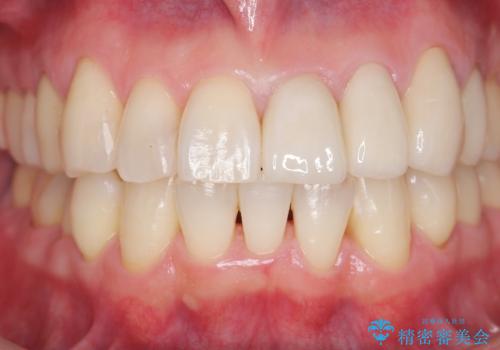 前歯の歯間に発生した虫歯のセラミック治療の治療後