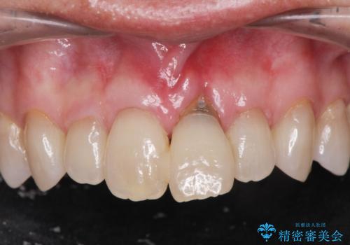 [ 欠損部の著しい骨欠損 ]　歯ぐきのボリュームを回復し自然なブリッジ作製治療の症例 治療前