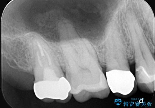 全ての銀歯をセラミックへ。お口全体をメタルフリーにして笑顔まで明るくの治療後