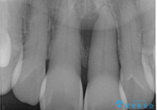 [ 欠損部の著しい骨欠損 ]　歯ぐきのボリュームを回復し自然なブリッジ作製治療の治療前