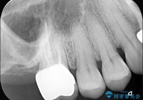 詰め物が外れた奥歯。MB2の発見の治療後