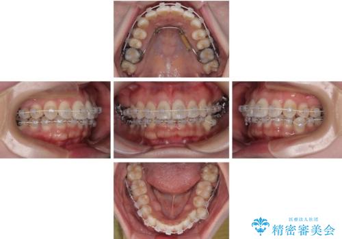 デコボコと正中のずれを改善した矯正治療の治療中