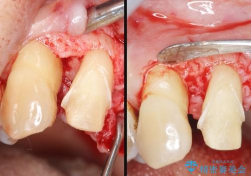 [ 再生療法 ]  歯周病治療を行った前歯のセラミック治療