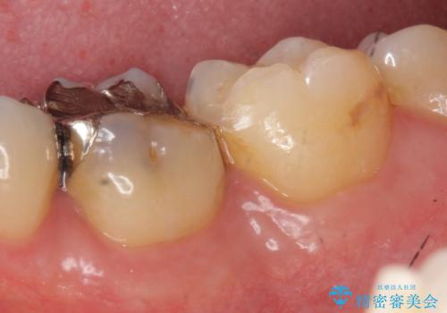 [ セラミック治療 ]  清掃性の悪い修復物を改善の症例 治療前