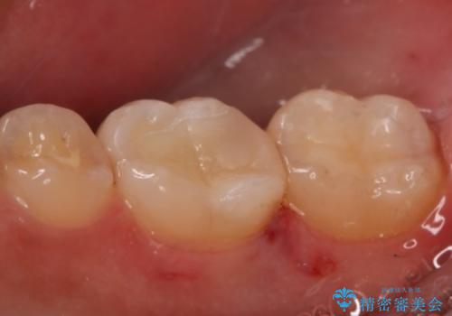 奥歯を良いもので治したい セラミックインレーの治療後