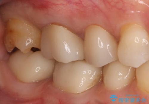 銀歯をやり変えたい　セラミックインレーの治療中