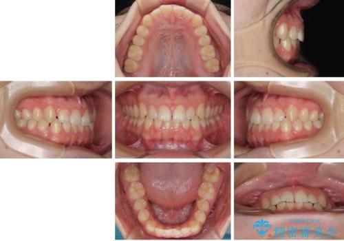 すきっ歯は放置NG?インビザラインで目立たず改善の治療前